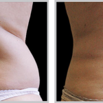 Cool Sculpting 31, before and after picture of lower back front view