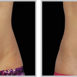 Cool Sculpting 41, before and after picture of stomach front view