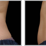 Cool Sculpting 51, before and after picture of stomach profile