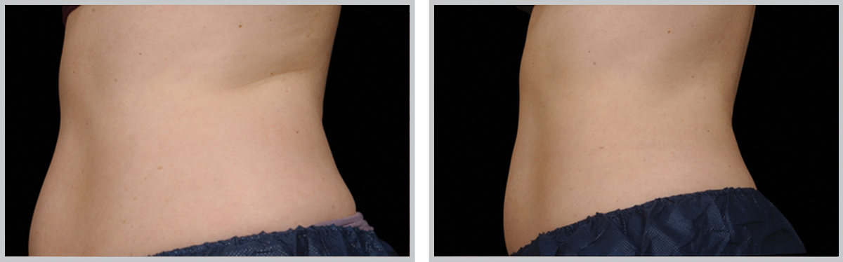Cool Sculpting 51, before and after picture of stomach profile