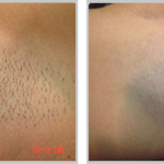 Laser Hair Removal 31, before and after picture of underarm